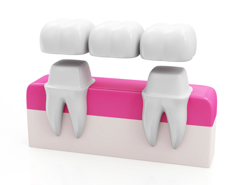 dental bridge concept